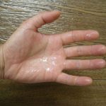 【手汗】多汗症レベル3の私が最後にたどり着いた治療法 (塩化アルミニウム?テサラン?)